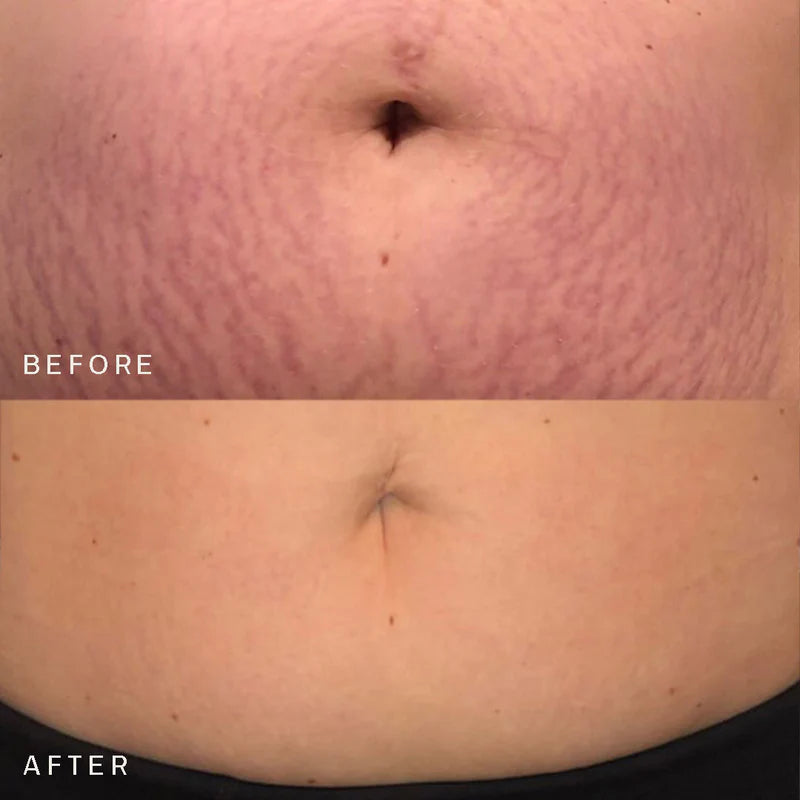 Silicone StretchMark Pack™